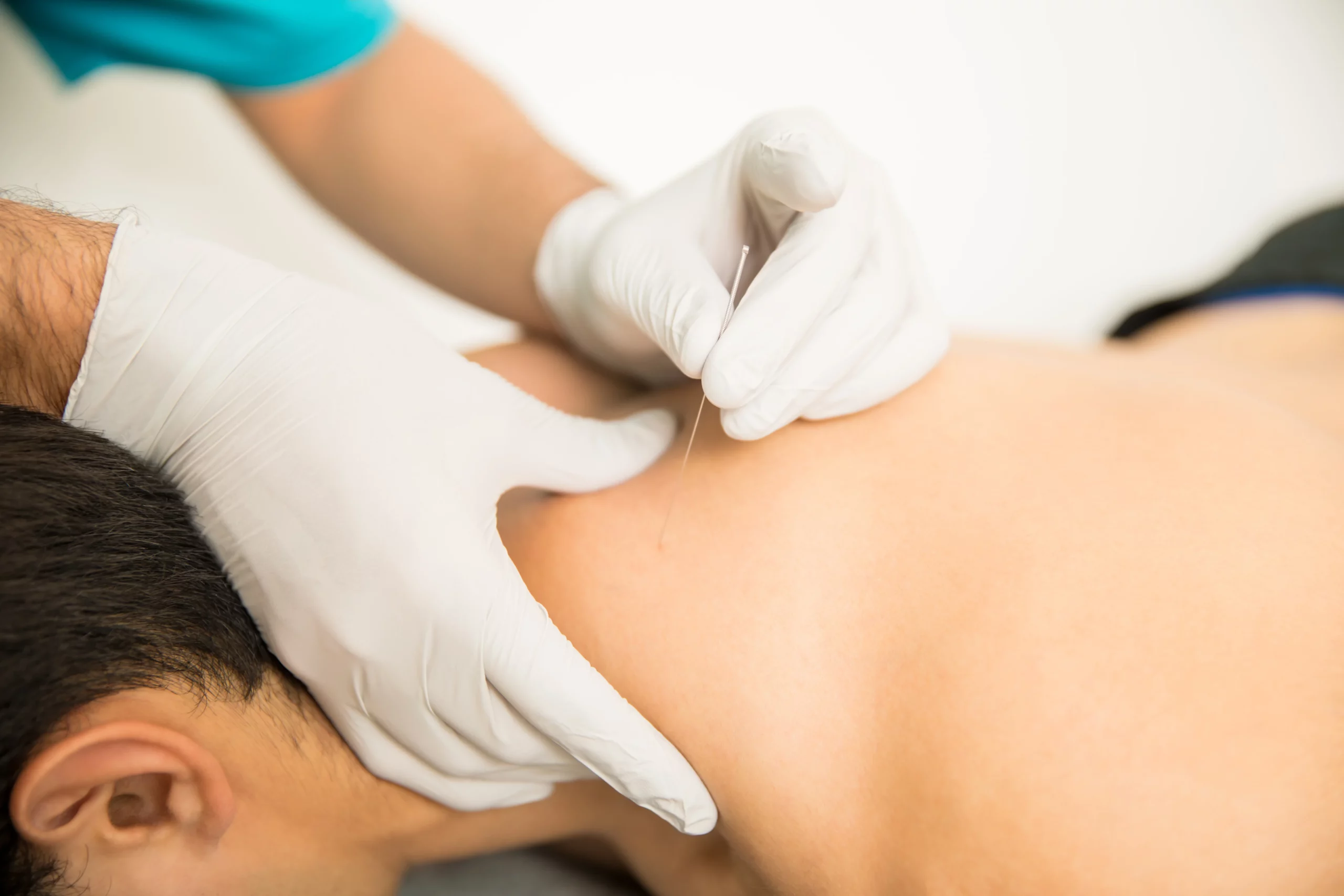 Dry Needling | concierge health and wellness |Montana|